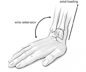 injury mechanism of a radial fracture